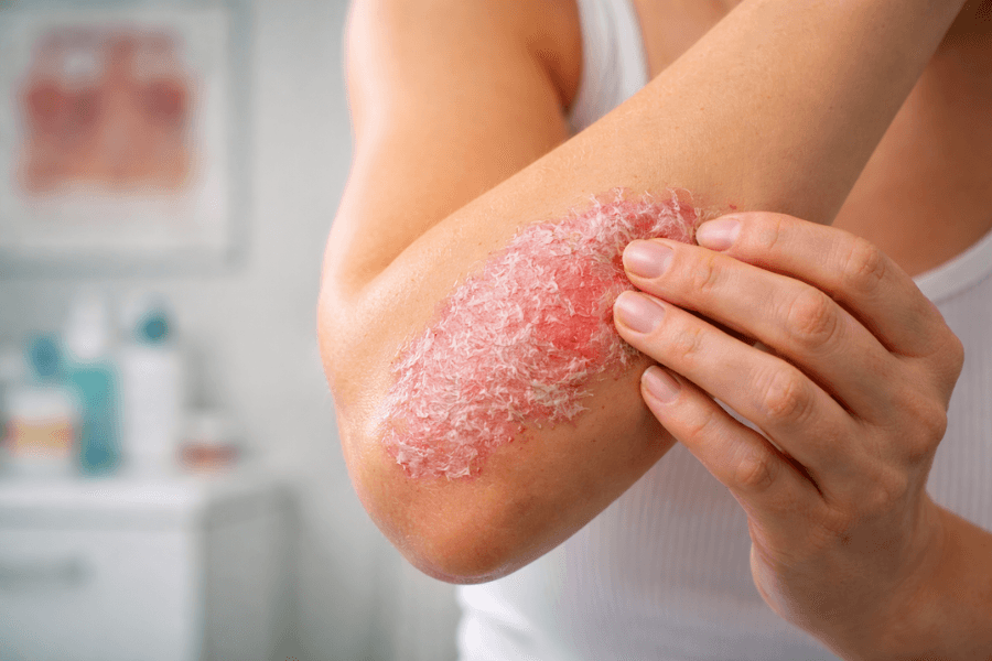 Naftalanda psoriazın müalicəsi – sübut olunmuş nəticə verən effektiv kurort üsulu