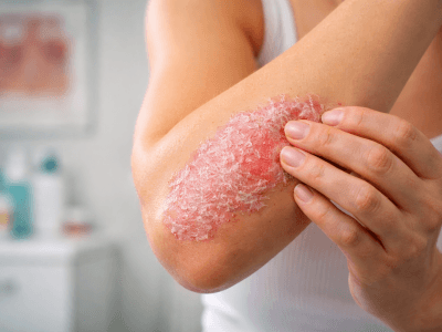 Naftalanda psoriazın müalicəsi – sübut olunmuş nəticə verən effektiv kurort üsulu